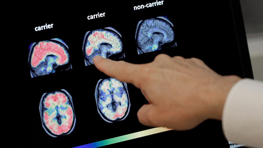 Can Artificial Intelligence help identify people at risk of developing Alzheimer’s?